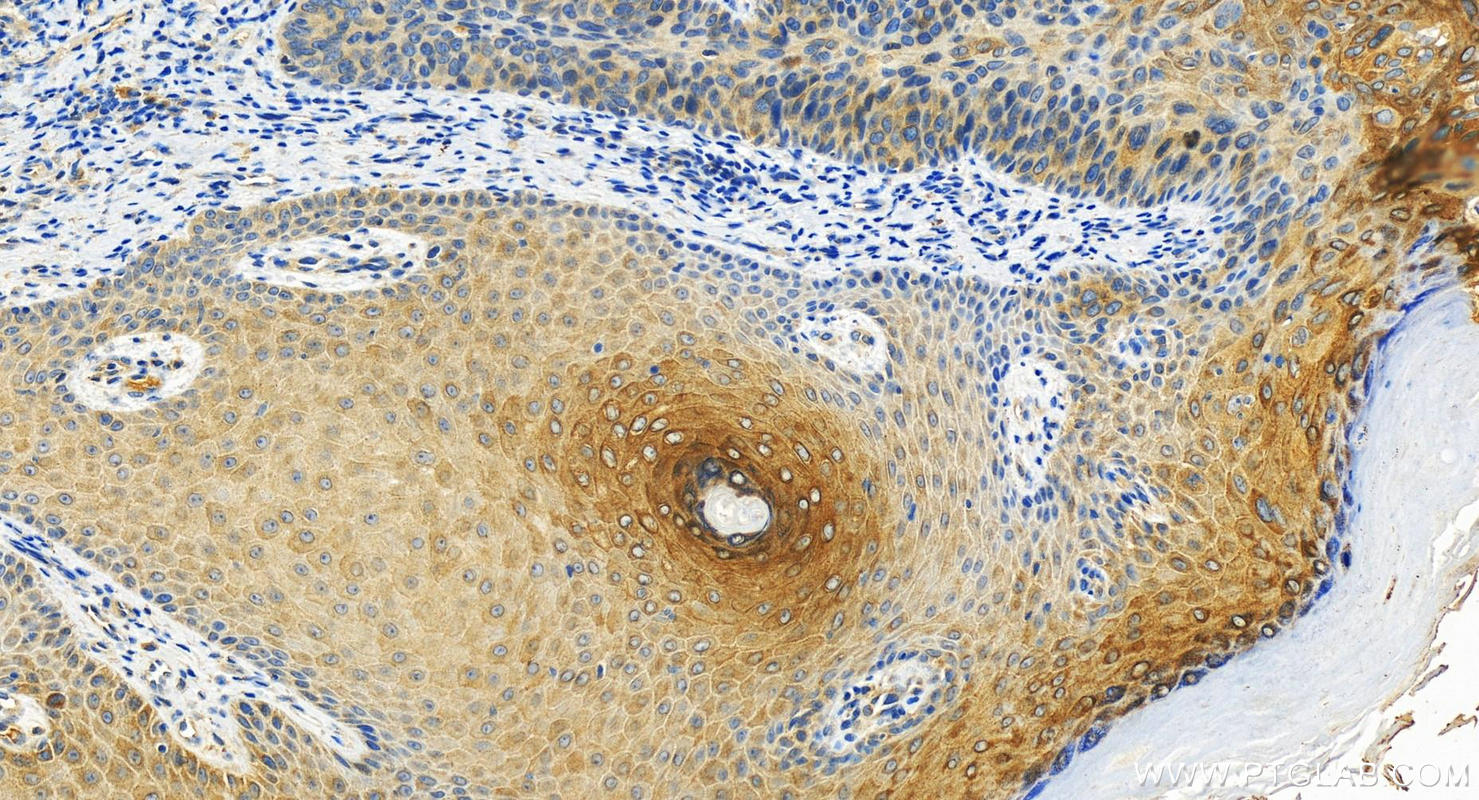 IHC staining of human bowen disease using 12286-1-AP