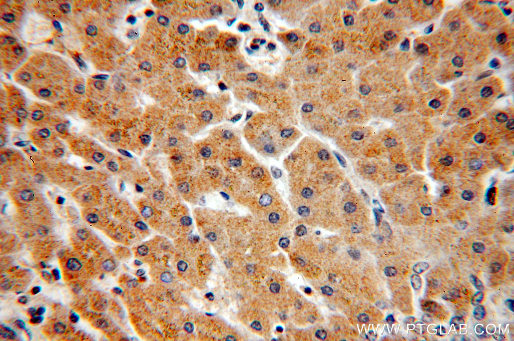 IHC staining of human hepatocirrhosis using 20012-1-AP