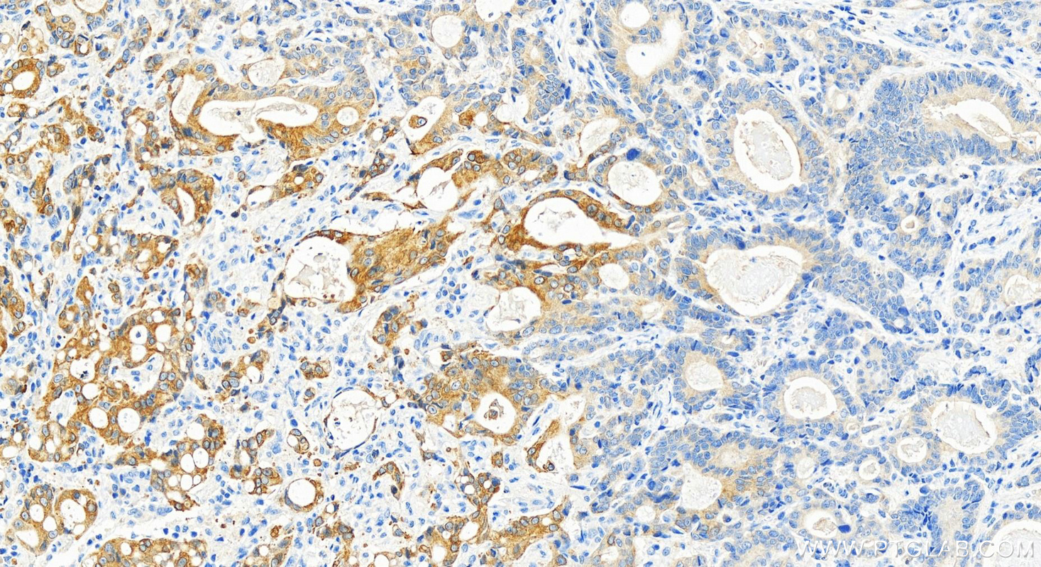 IHC staining of human stomach cancer using 13243-1-AP