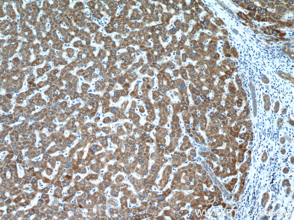 IHC staining of human liver cancer using 24889-1-AP