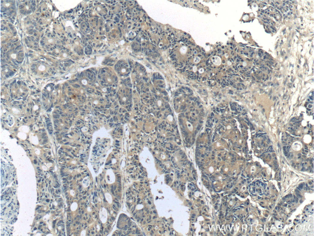 IHC staining of human pancreas cancer using 24133-1-AP