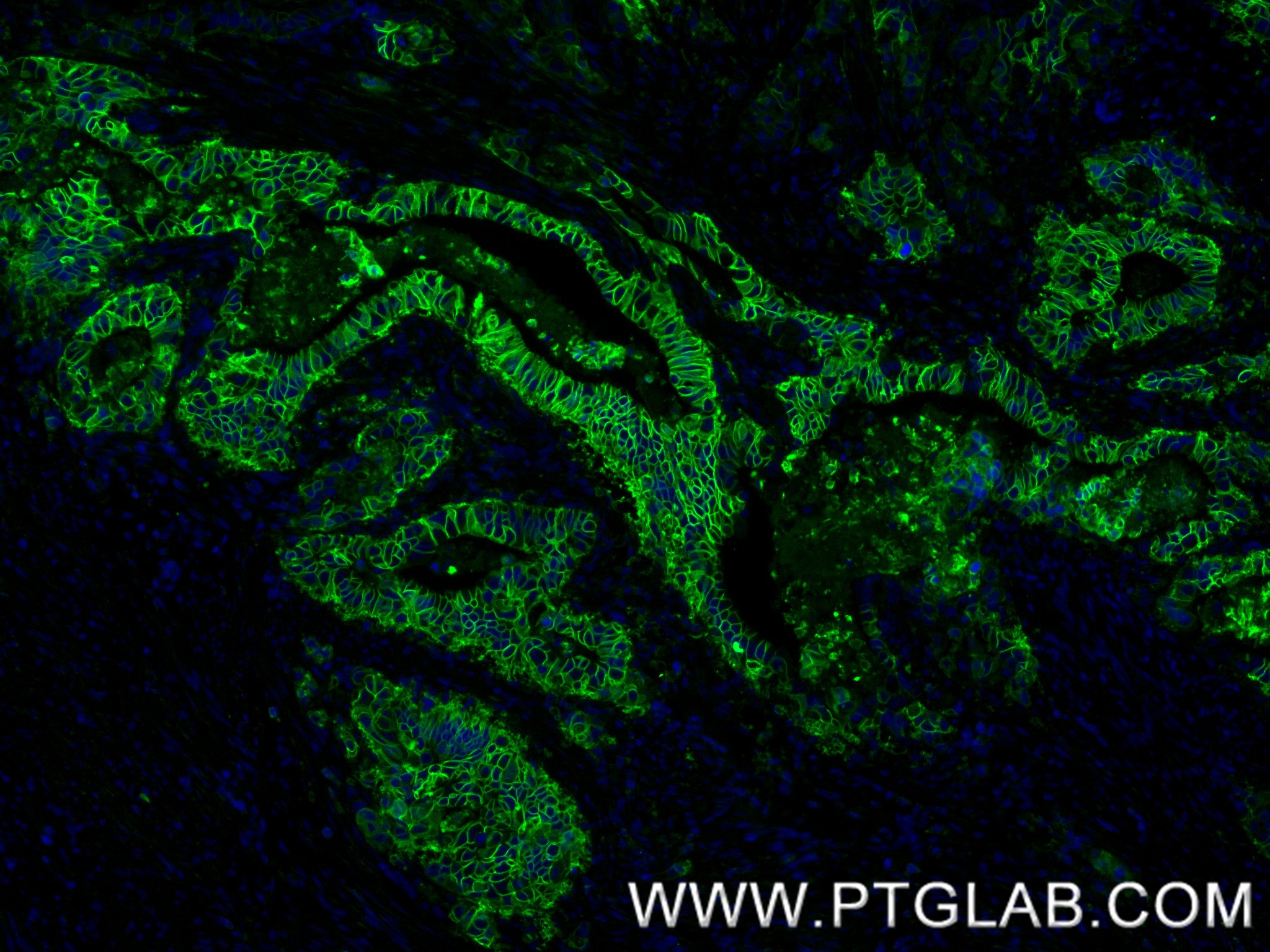 IF Staining of human stomach cancer using 83793-5-RR (same clone as 83793-5-PBS)