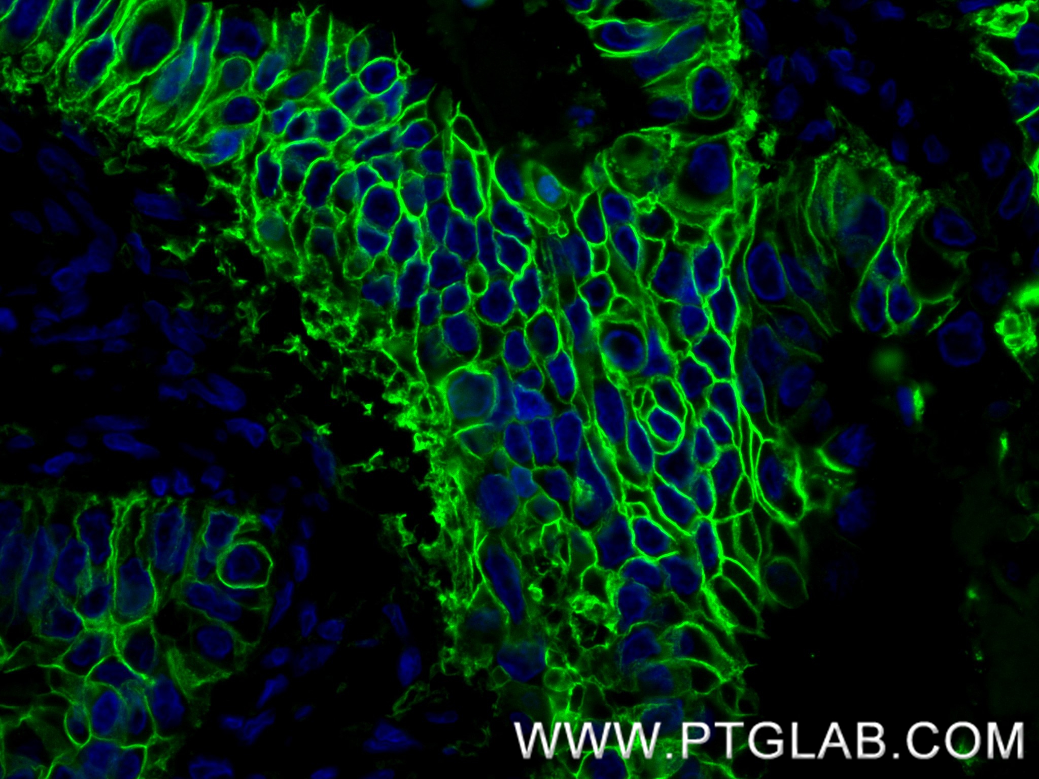 IF Staining of human stomach cancer using 83793-5-RR (same clone as 83793-5-PBS)