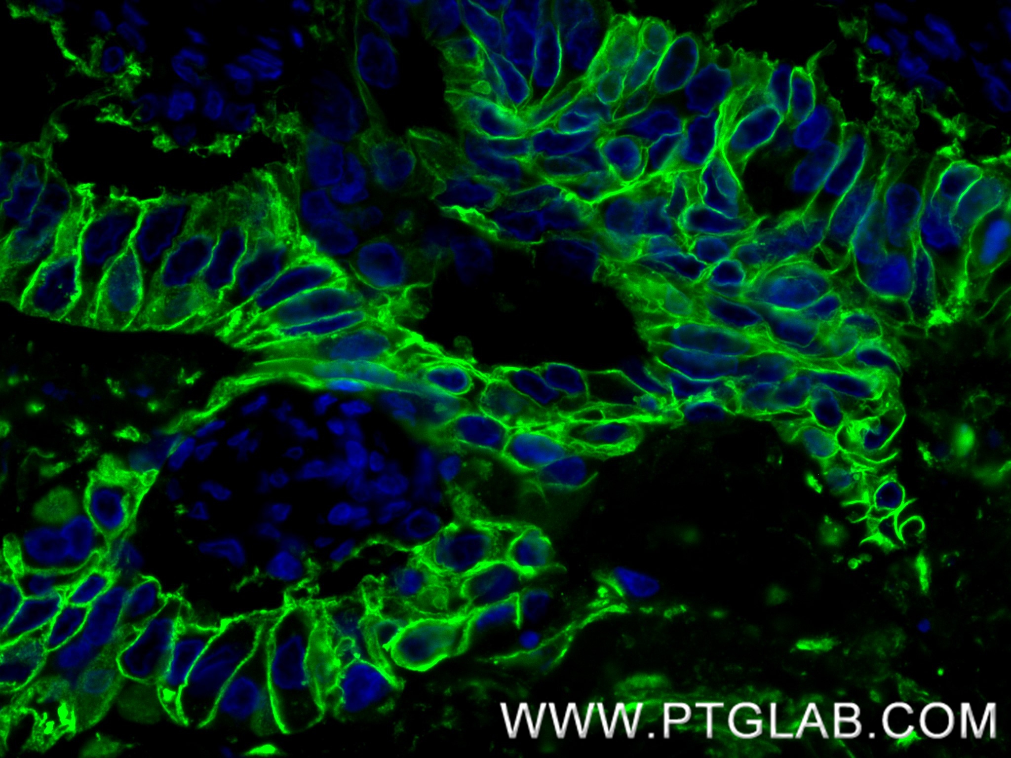 IF Staining of human stomach cancer using 83793-5-RR (same clone as 83793-5-PBS)