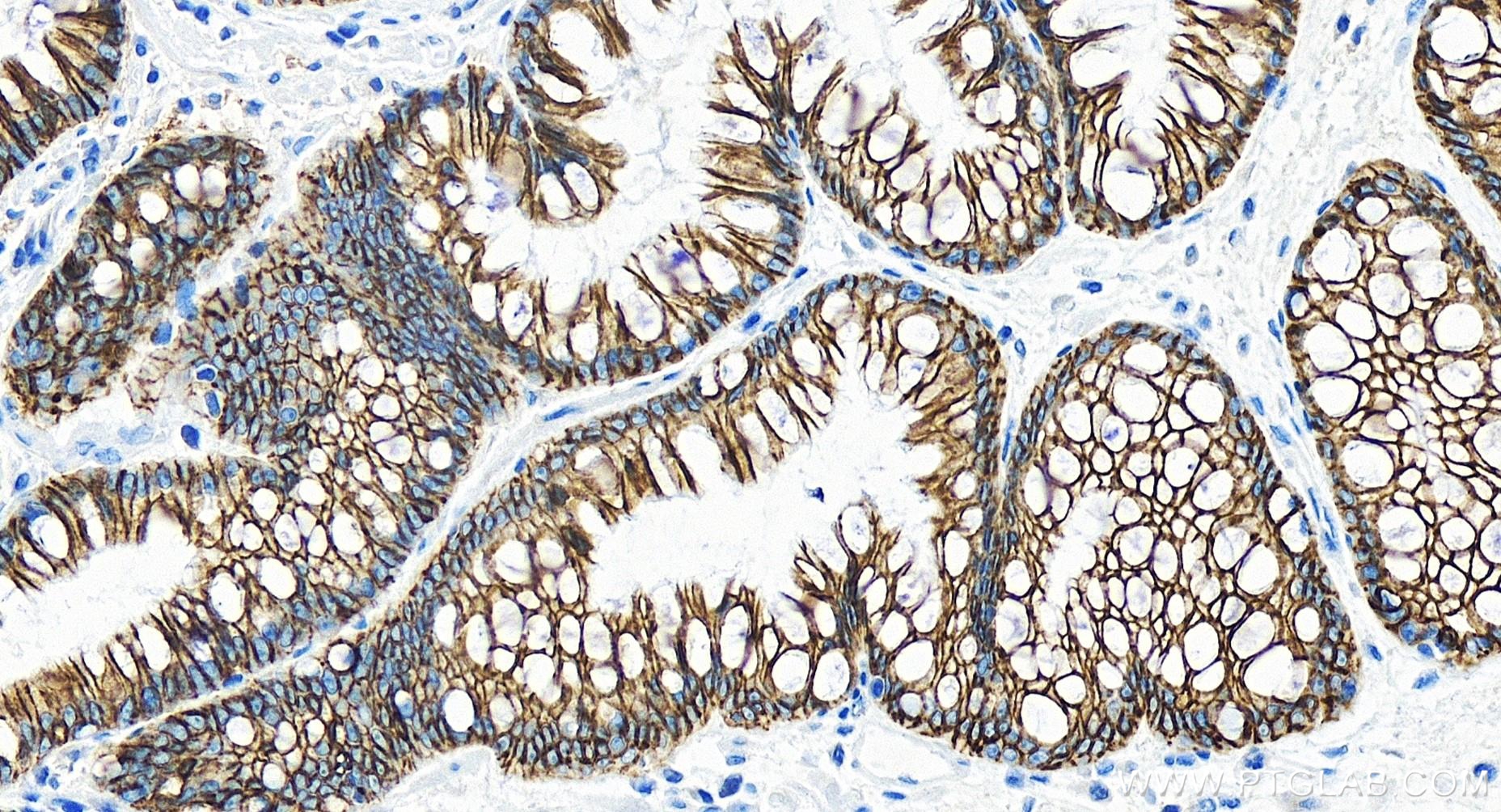 IHC staining of human stomach cancer using 83793-5-RR