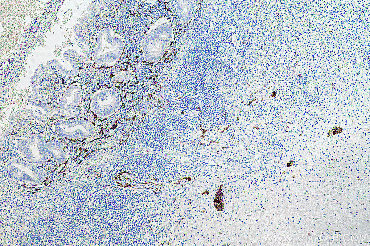 IHC staining of human appendicitis using 66496-1-Ig