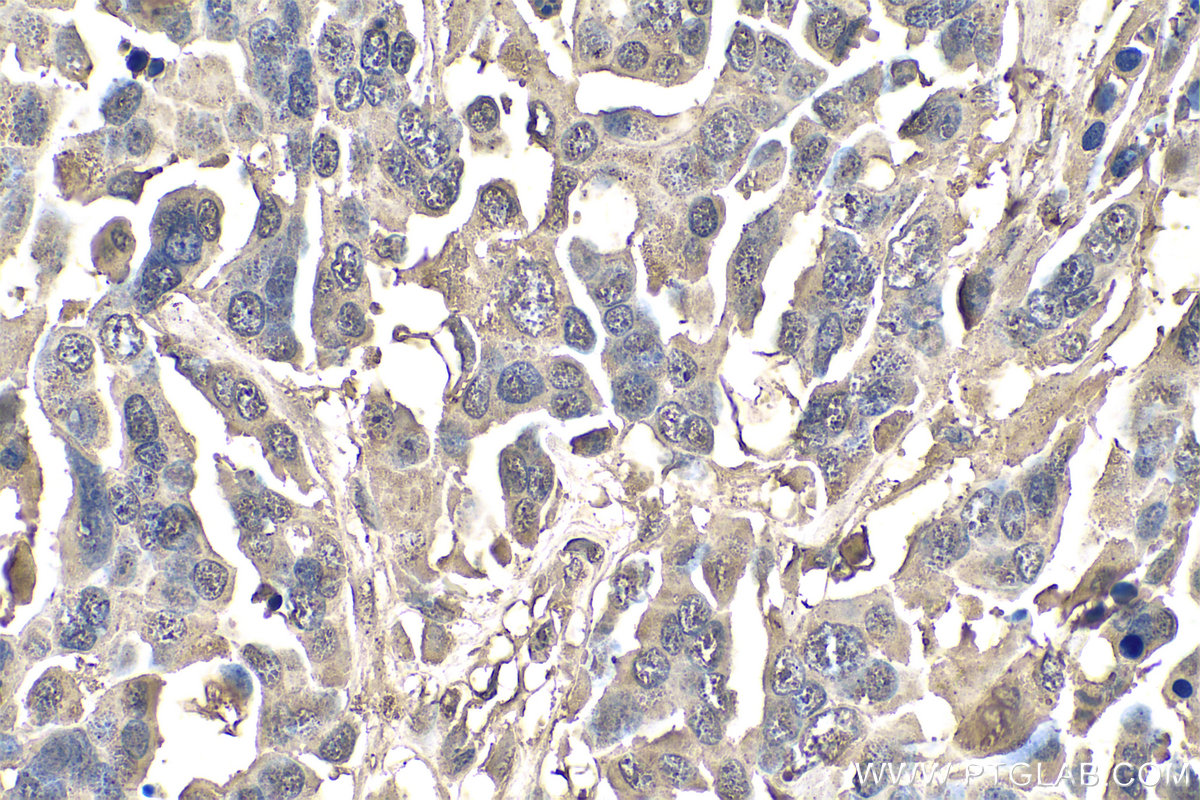 IHC staining of human colon cancer using 67585-1-Ig (same clone as 67585-1-PBS)