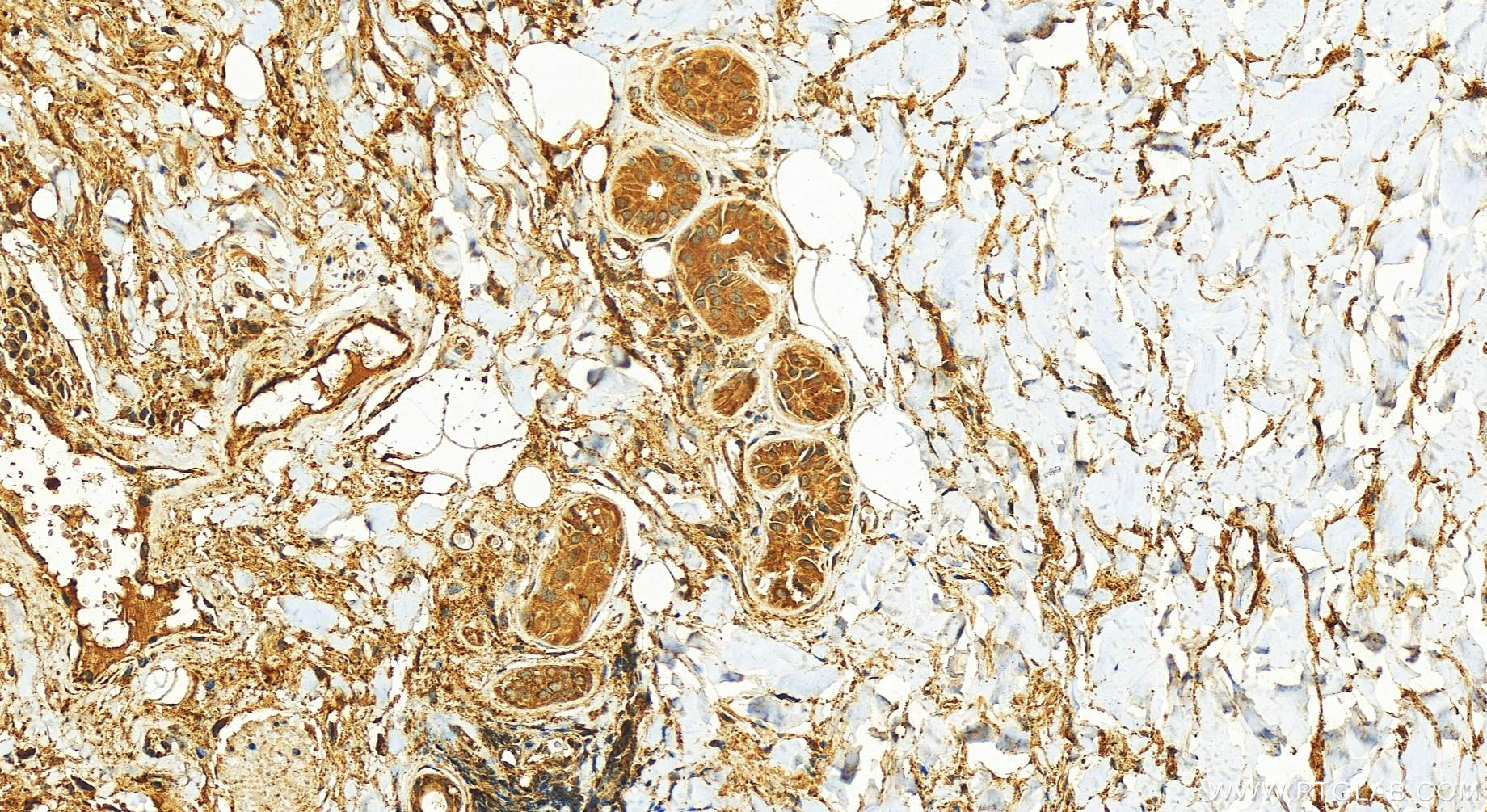 IHC staining of human skin cancer using 30790-1-AP