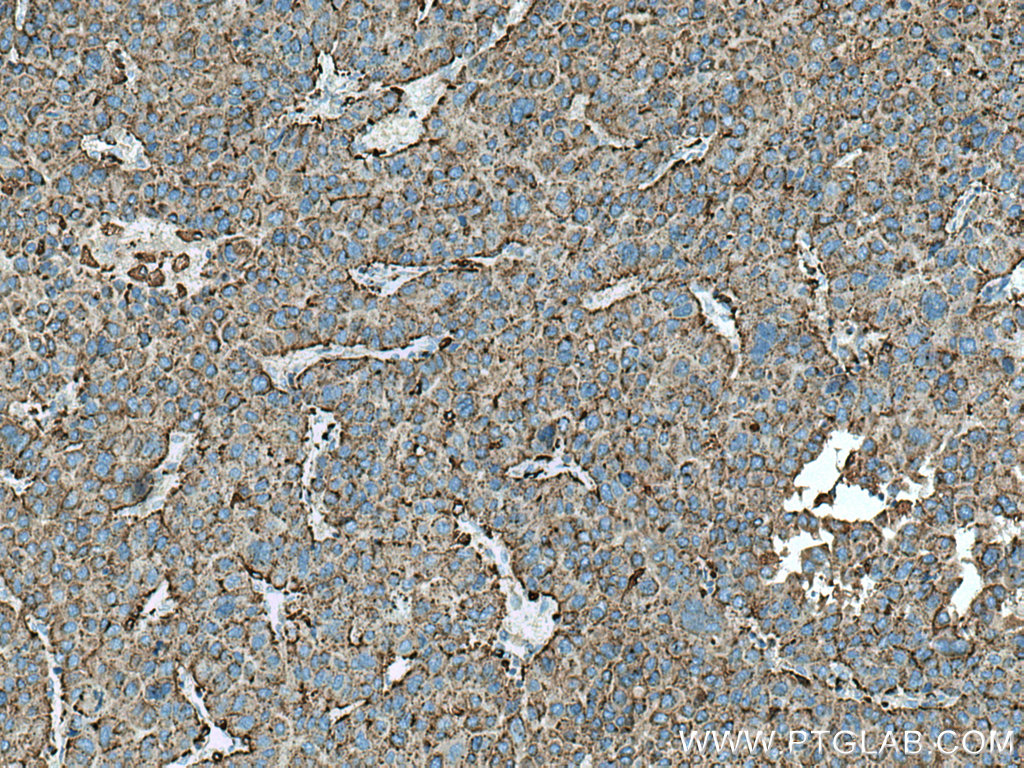 IHC staining of human liver cancer using 66534-1-Ig (same clone as 66534-1-PBS)