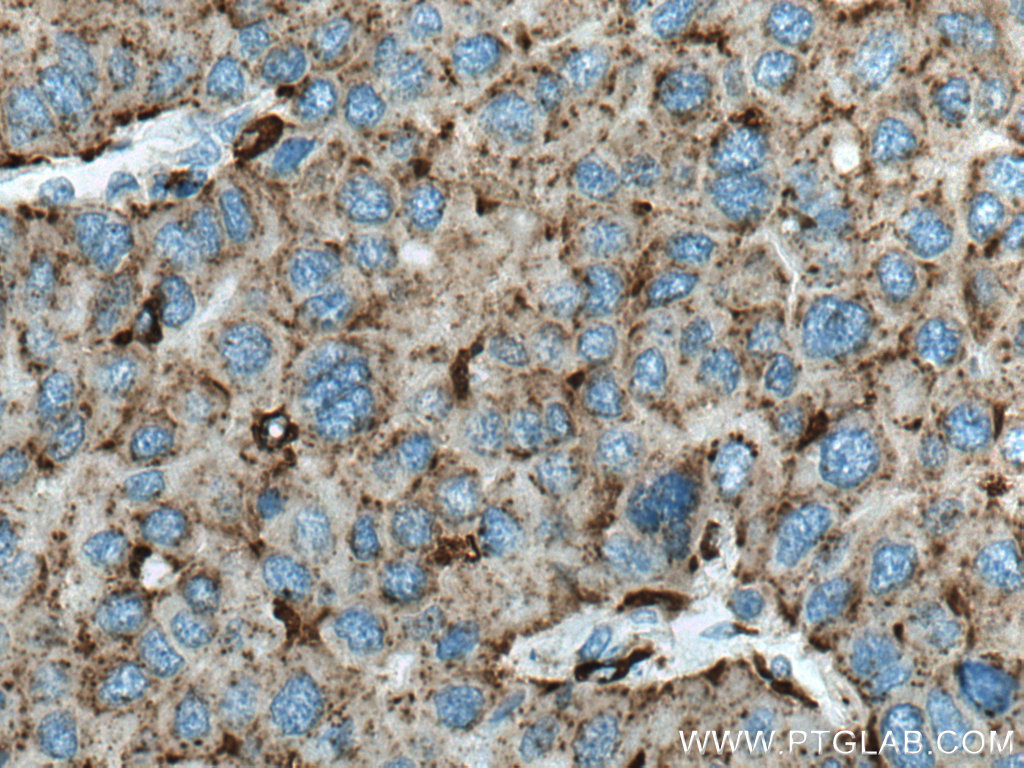 IHC staining of human liver cancer using 66534-1-Ig (same clone as 66534-1-PBS)