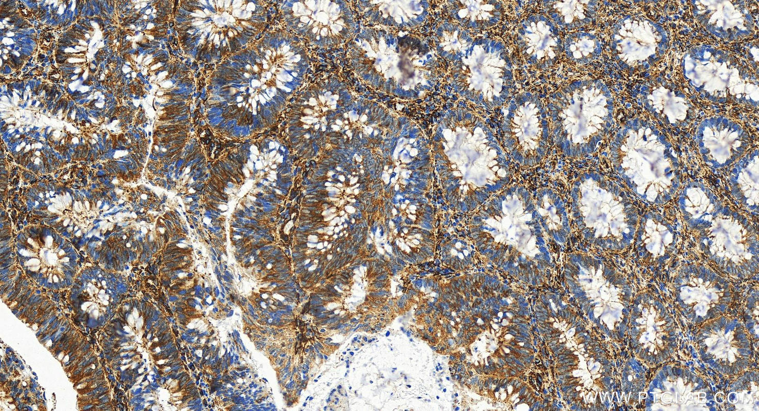 IHC staining of human colon cancer using 84044-1-RR (same clone as 84044-1-PBS)