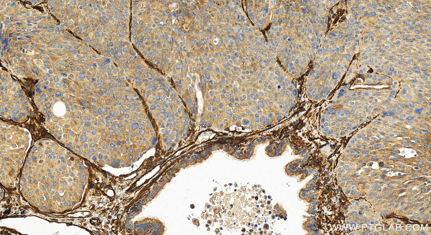 IHC staining of human lung squamous cell carcinoma using 84044-1-RR (same clone as 84044-1-PBS)