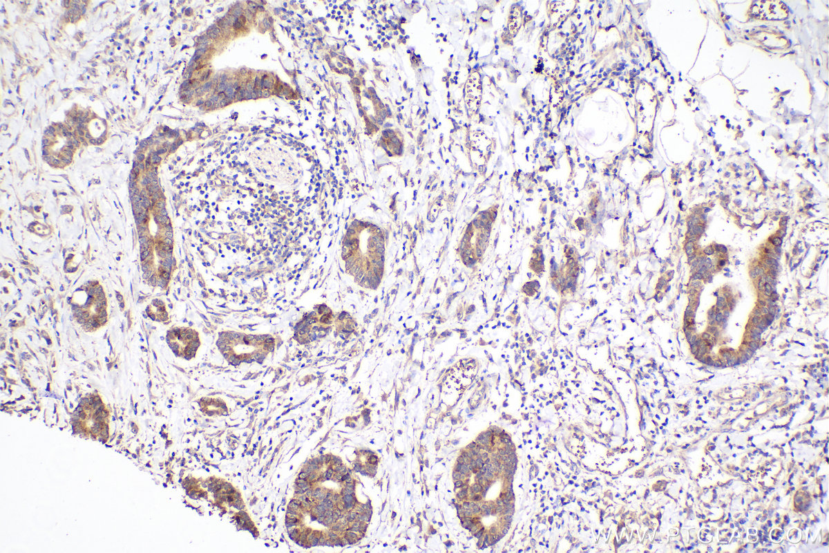 IHC staining of human rectal cancer using 67631-1-Ig (same clone as 67631-1-PBS)