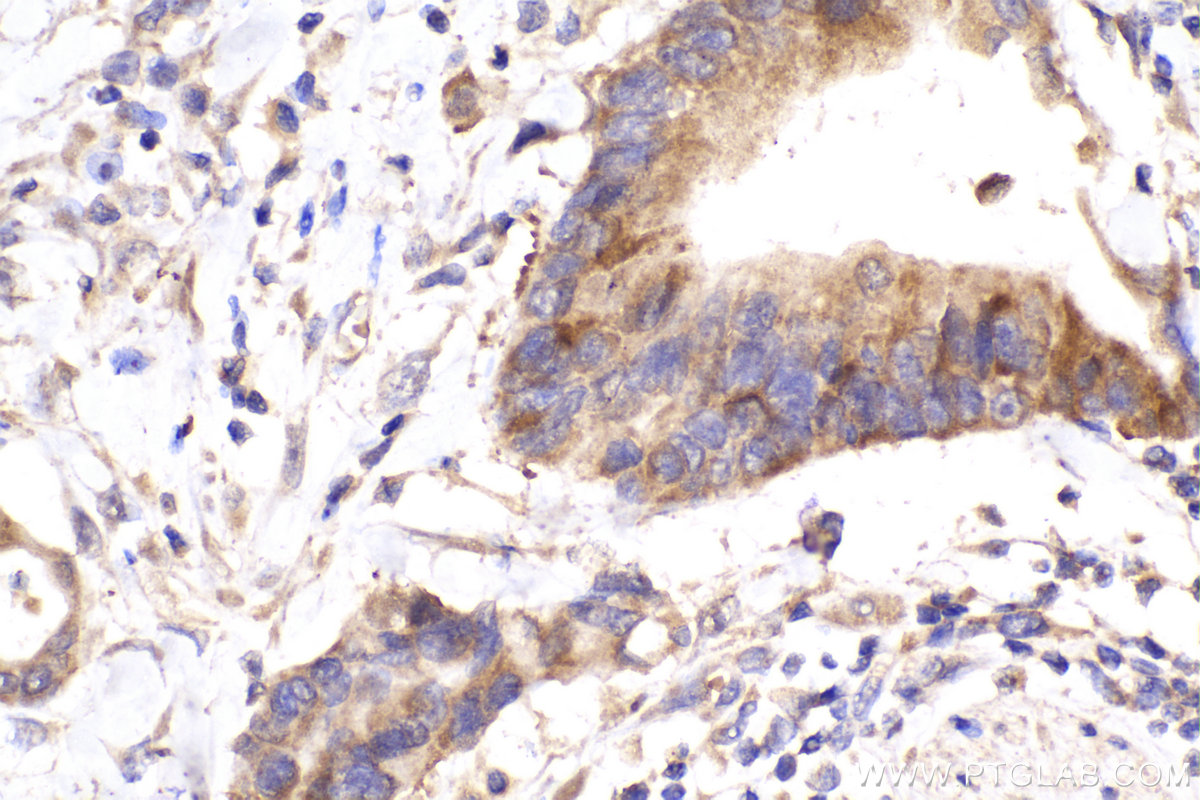 IHC staining of human rectal cancer using 67631-1-Ig (same clone as 67631-1-PBS)