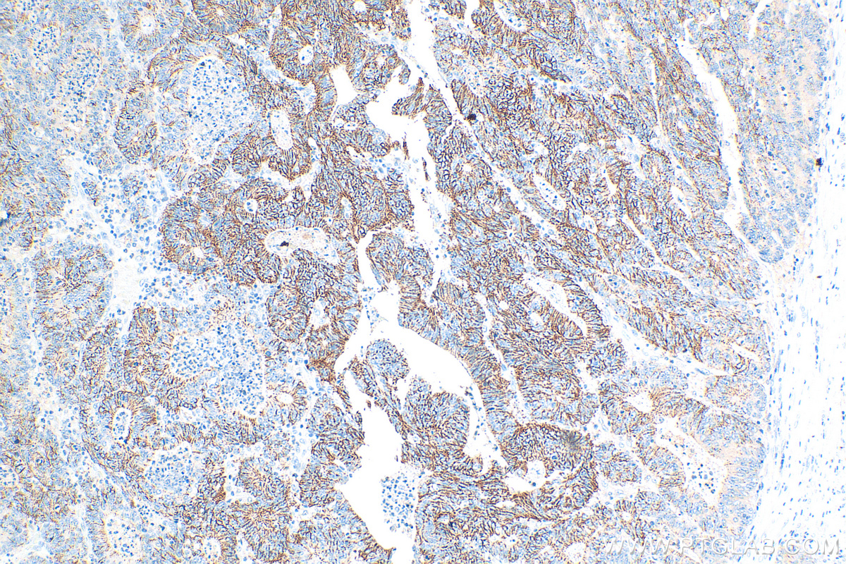 IHC staining of human colon cancer using 28674-1-AP