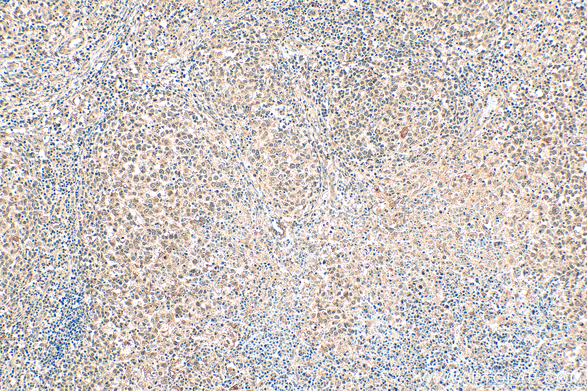 IHC staining of human lymphoma using 68773-1-Ig (same clone as 68773-1-PBS)