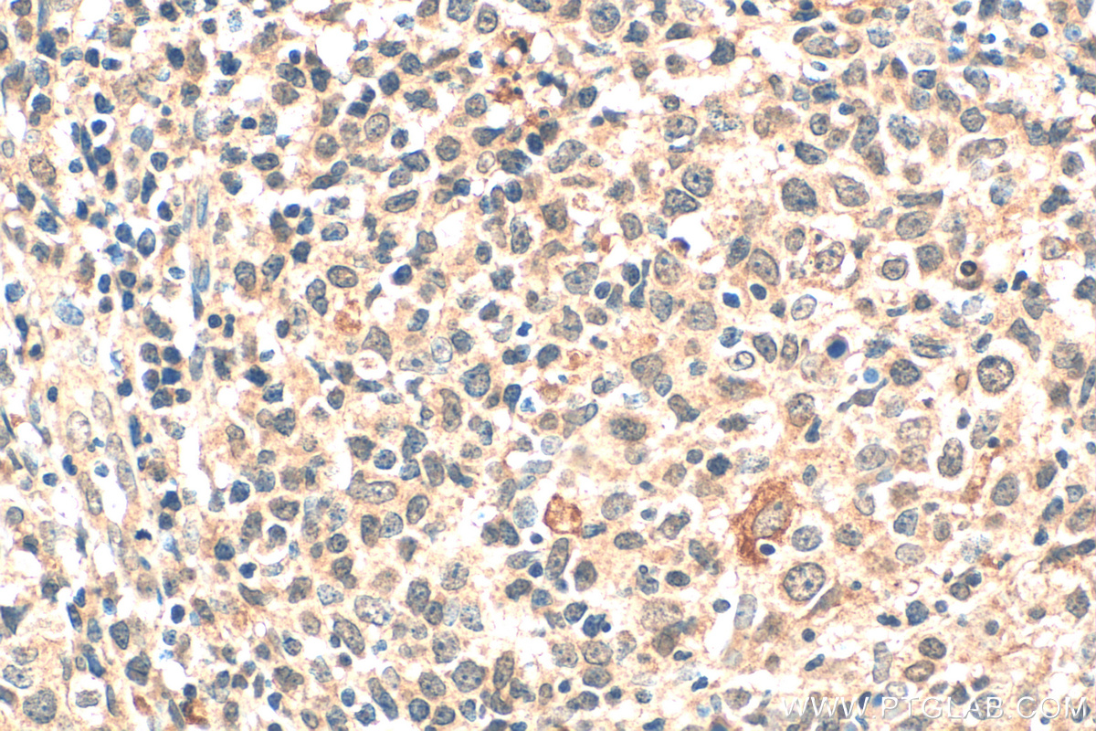 IHC staining of human lymphoma using 68773-1-Ig (same clone as 68773-1-PBS)