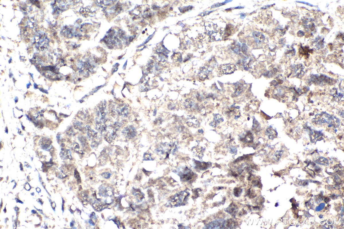 IHC staining of human ovary cancer using 68773-1-Ig (same clone as 68773-1-PBS)