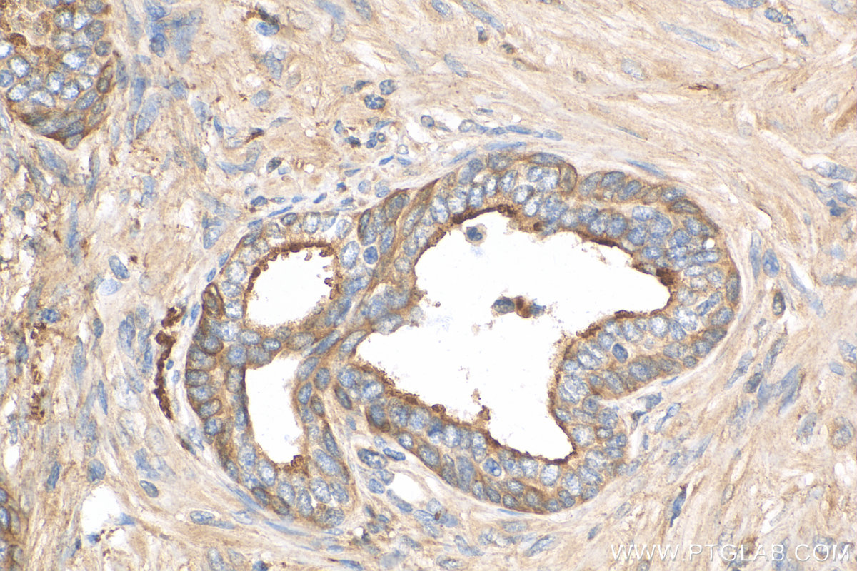 IHC staining of human prostate cancer using 30339-1-AP