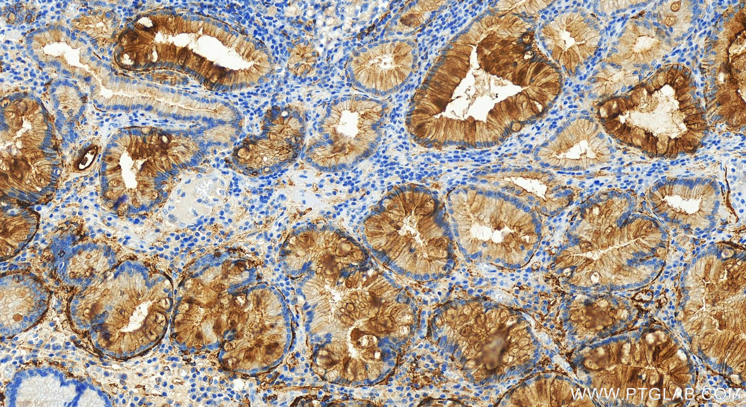 IHC staining of human stomach cancer using 83776-4-RR