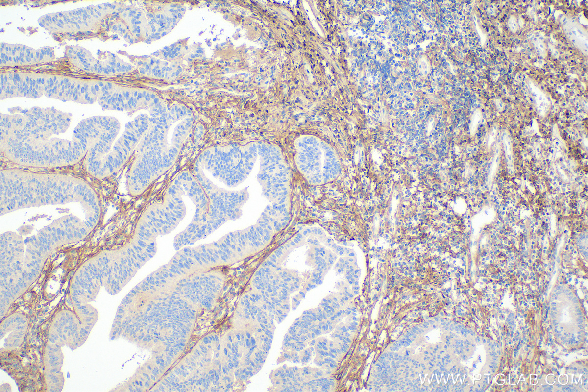 IHC staining of human colon cancer using 67288-1-Ig (same clone as 67288-1-PBS)