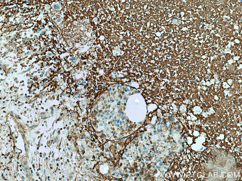 IHC staining of human breast cancer using 67604-1-Ig (same clone as 67604-1-PBS)