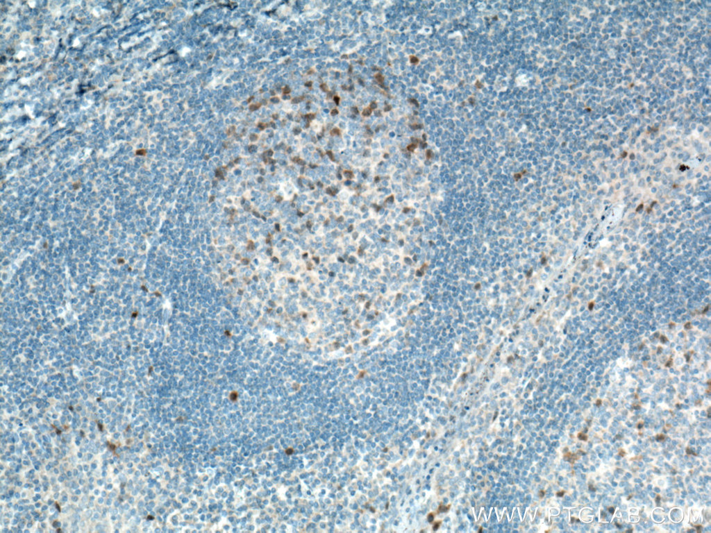 IHC staining of human tonsillitis using 66391-1-Ig (same clone as 66391-1-PBS)