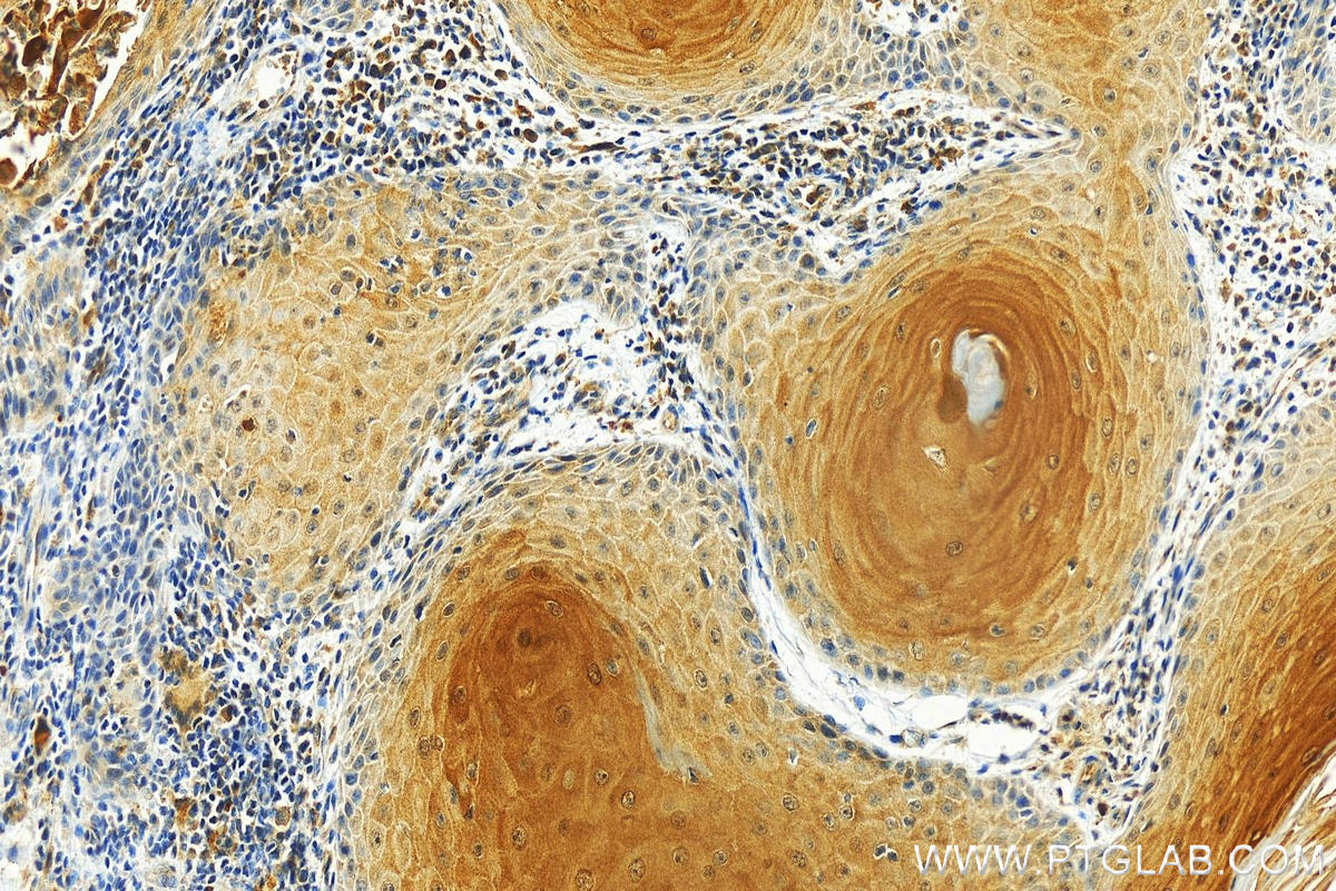 IHC staining of human skin cancer using 66812-1-Ig (same clone as 66812-1-PBS)