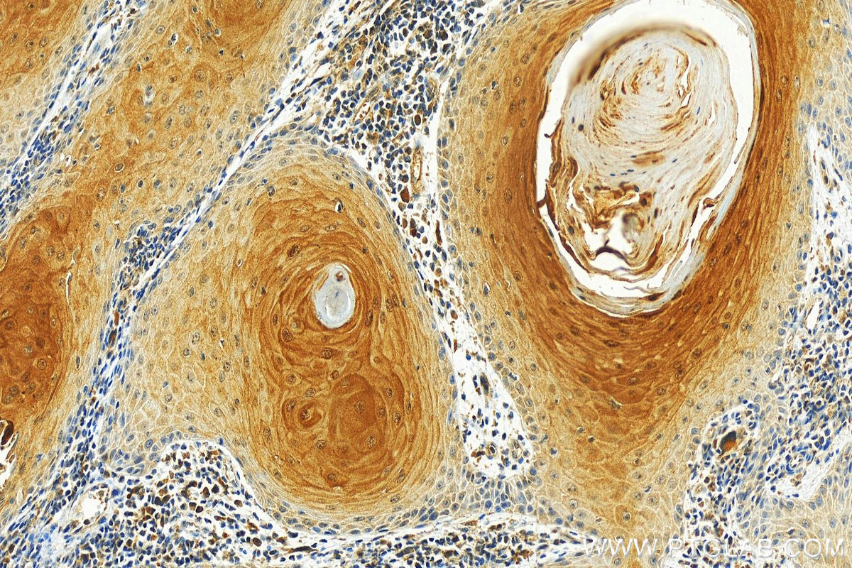 IHC staining of human skin cancer using 66812-1-Ig (same clone as 66812-1-PBS)