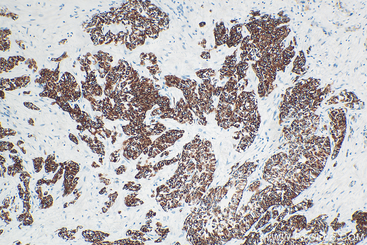 IHC staining of human urothelial carcinoma using 83058-1-RR (same clone as 83058-1-PBS)