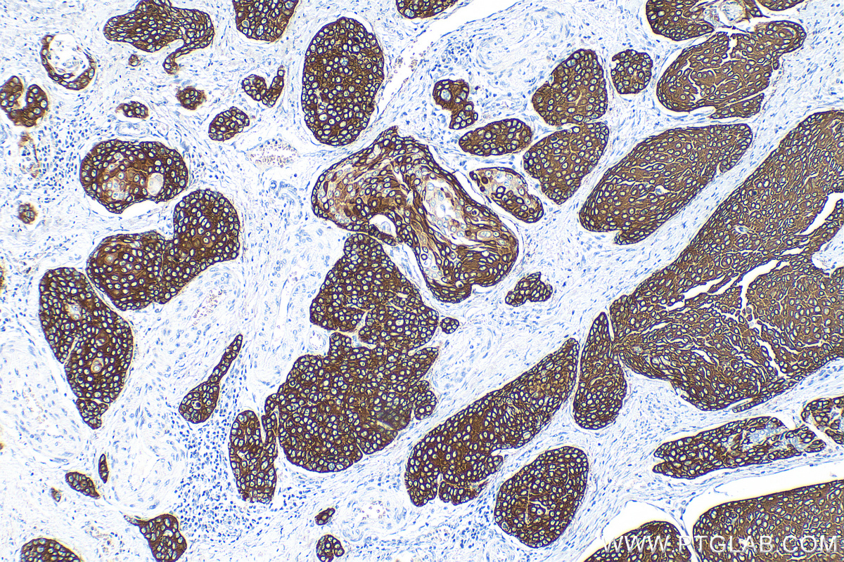 IHC staining of human oesophagus cancer using 82824-1-RR (same clone as 82824-1-PBS)