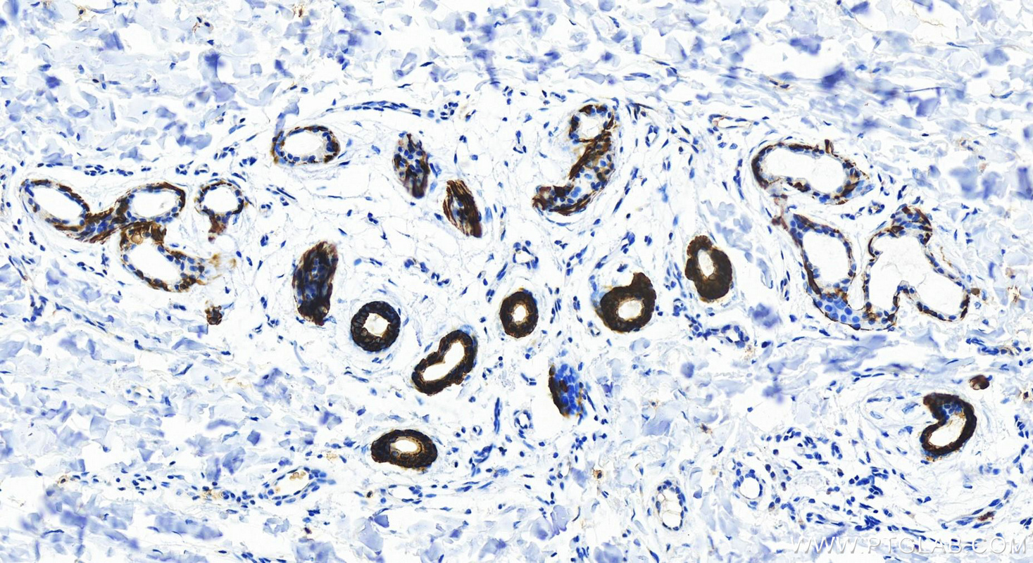 IHC staining of Human bowens disease using 82824-1-RR