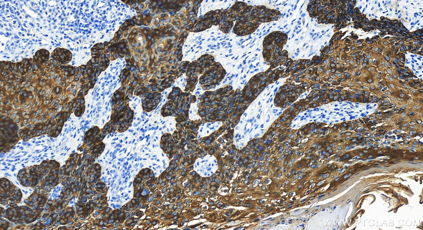 IHC staining of Human bowens disease using 82824-1-RR