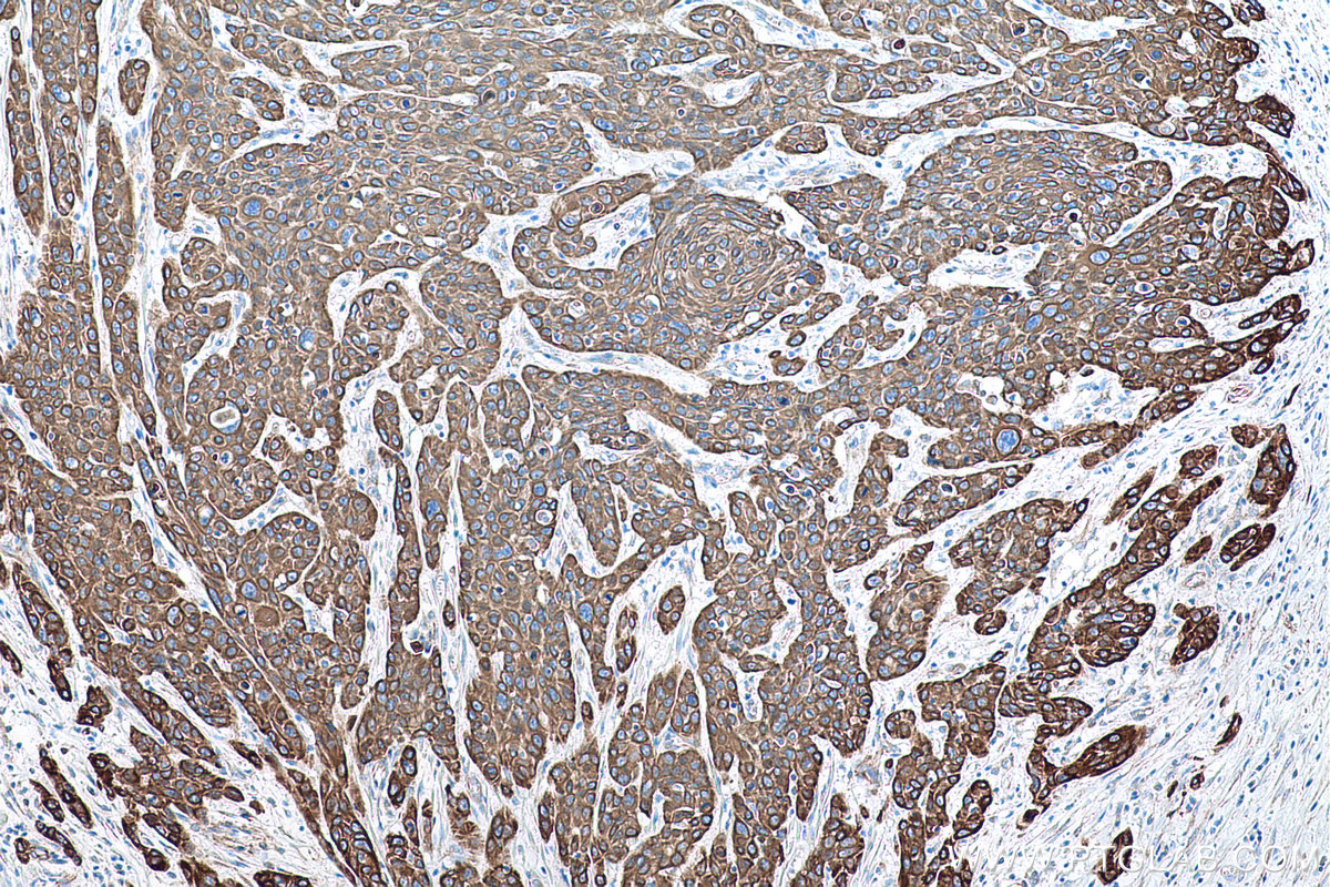 IHC staining of human oesophagus cancer using 66727-1-Ig (same clone as 66727-1-PBS)