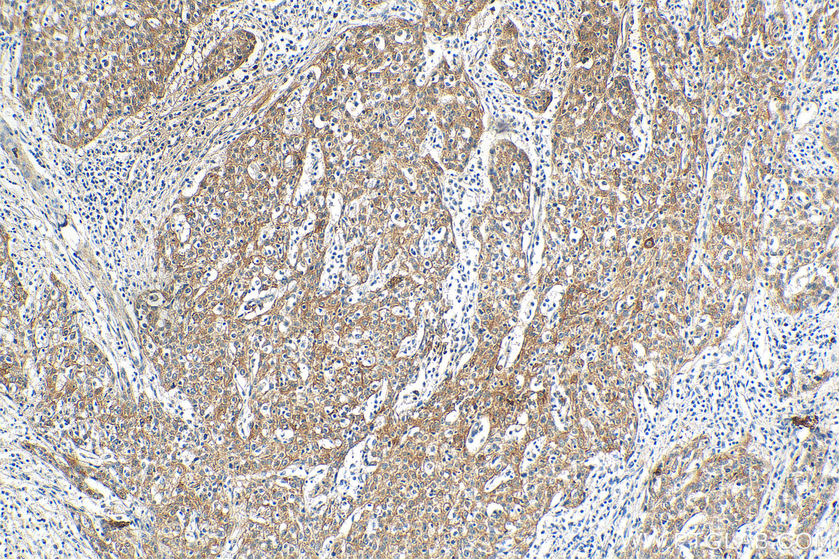 IHC staining of human cervical cancer using 66685-1-Ig