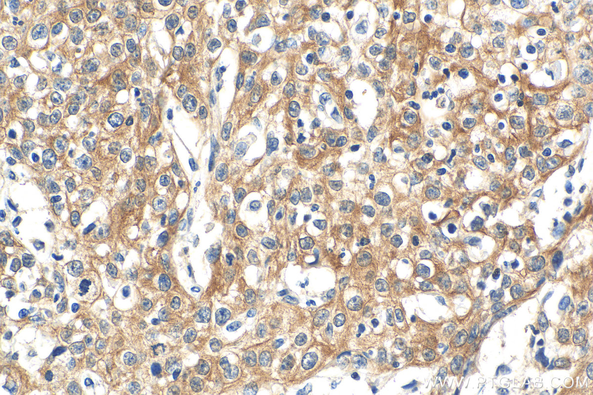 IHC staining of human cervical cancer using 66685-1-Ig