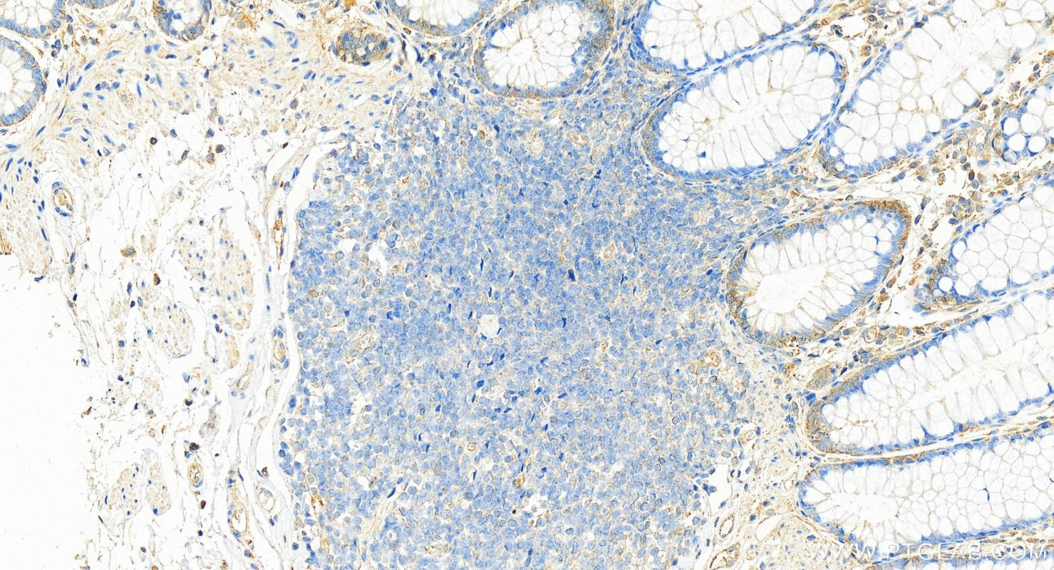 IHC staining of human colon using 68627-1-Ig (same clone as 68627-1-PBS)