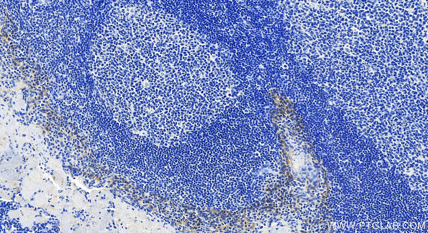 IHC staining of human tonsillitis using 68627-1-Ig