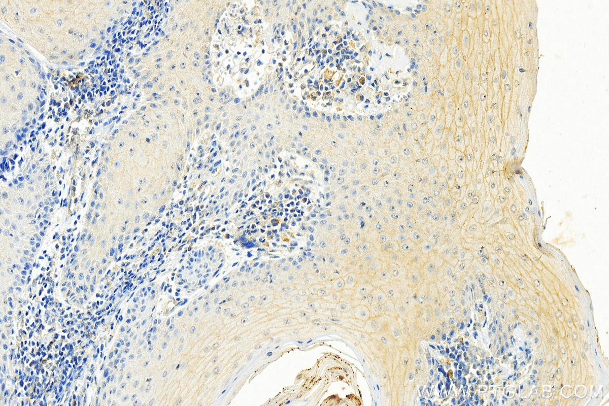 IHC staining of human skin cancer using 67287-1-Ig