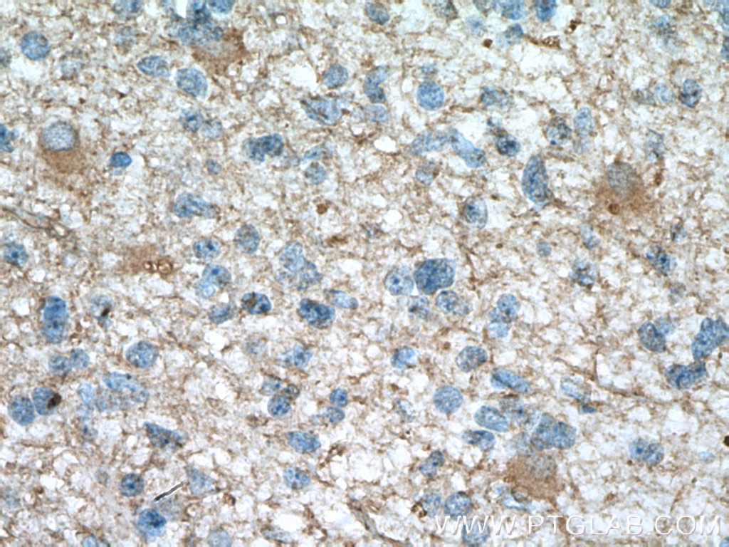 IHC staining of human gliomas using 66296-1-Ig