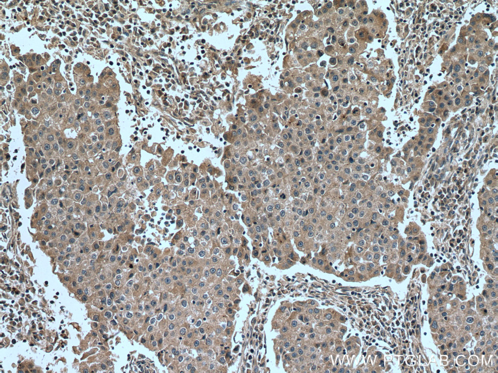 IHC staining of human breast cancer using 67815-1-Ig (same clone as 67815-1-PBS)