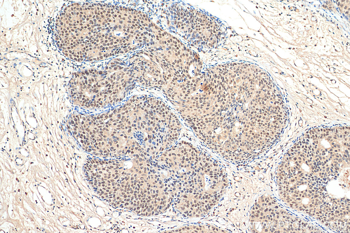 IHC staining of human breast cancer using 67879-1-Ig (same clone as 67879-1-PBS)
