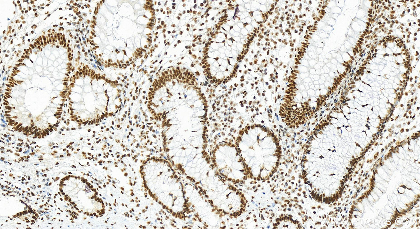 IHC staining of human colon cancer using 22638-1-AP