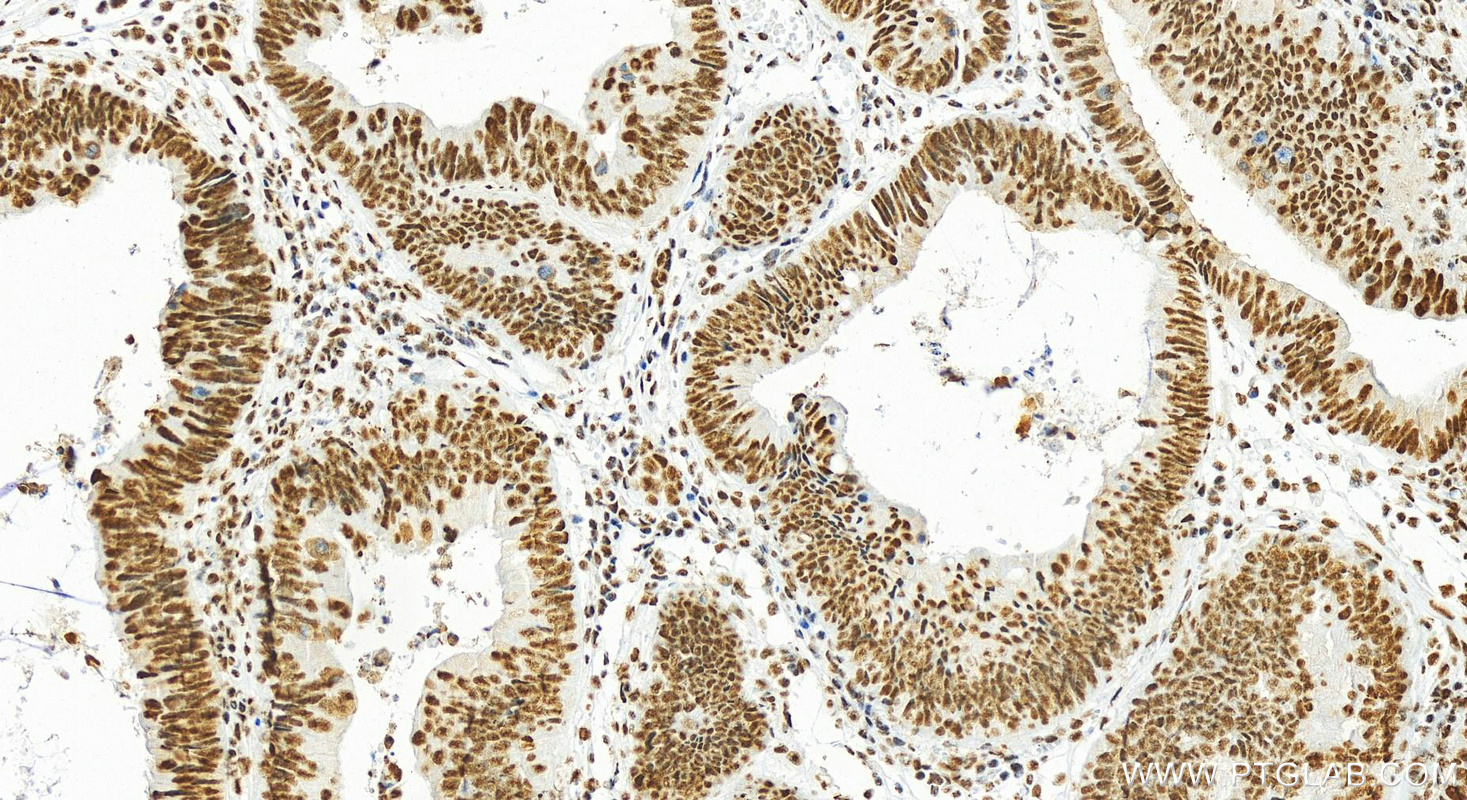 IHC staining of human colon cancer using 22638-1-AP