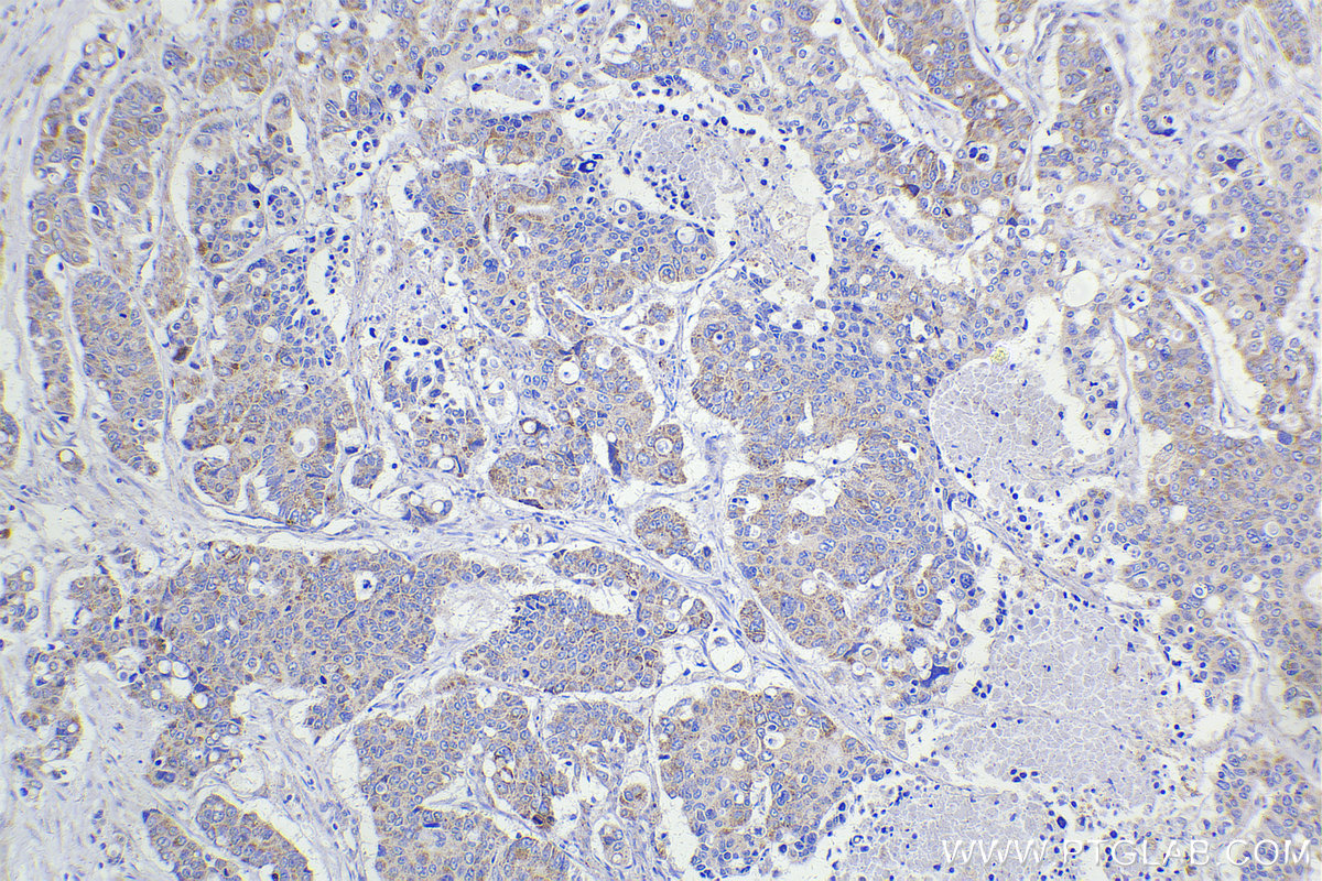 IHC staining of human stomach cancer using 12451-1-AP