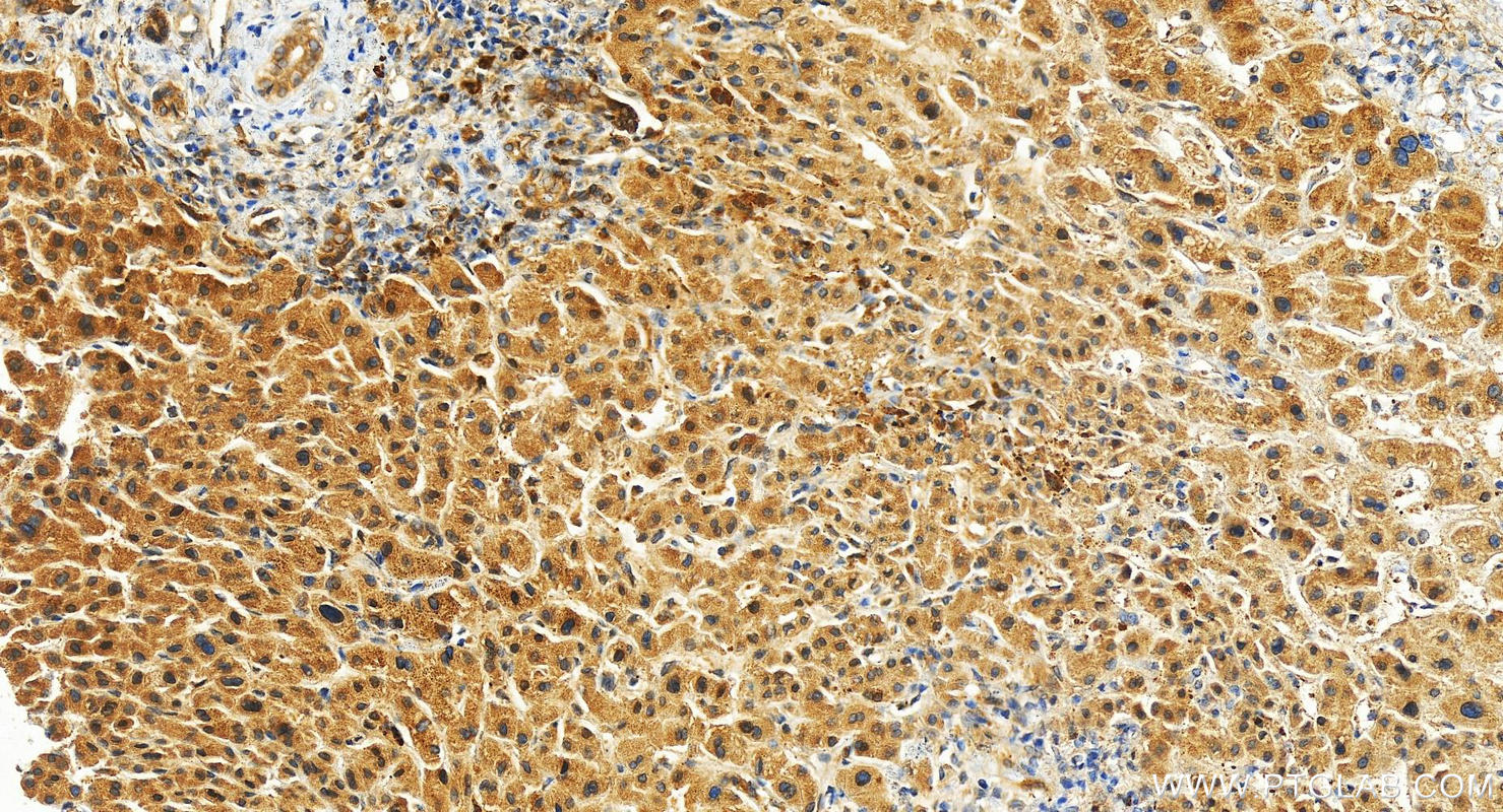 IHC staining of human intrahepatic cholangiocarcinoma using 13168-1-AP