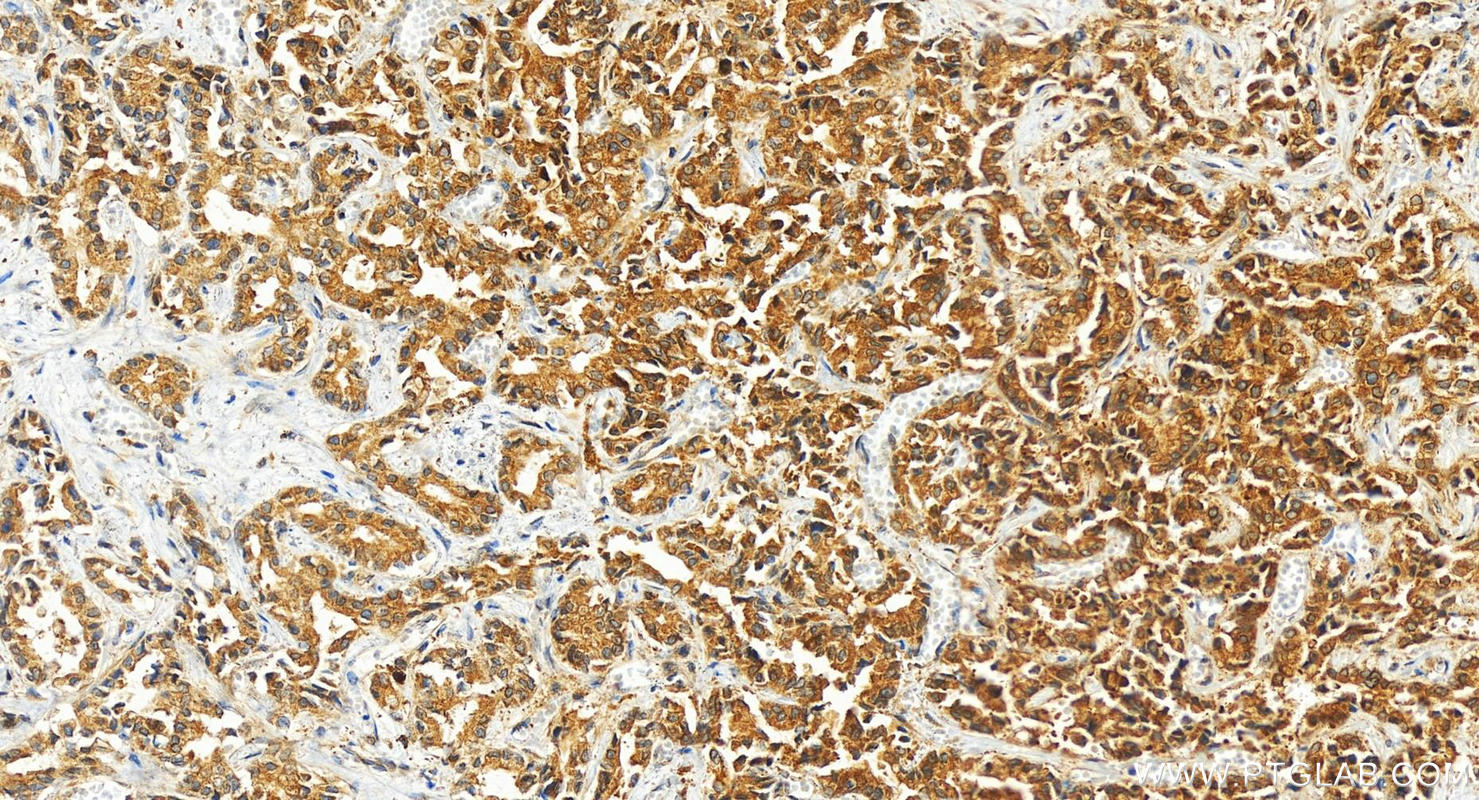 IHC staining of human intrahepatic cholangiocarcinoma using 13168-1-AP