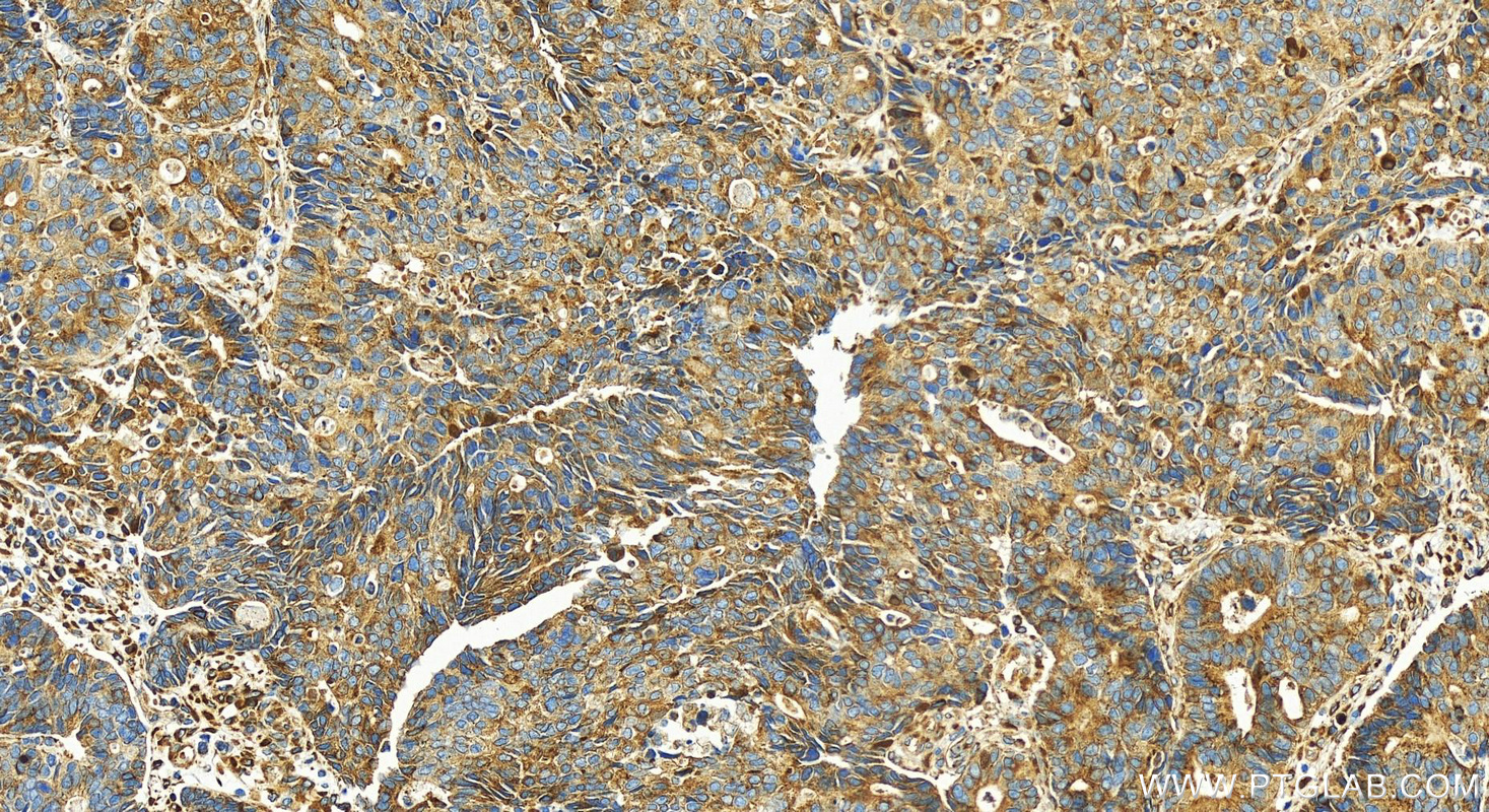 IHC staining of human stomach cancer using 30245-1-AP