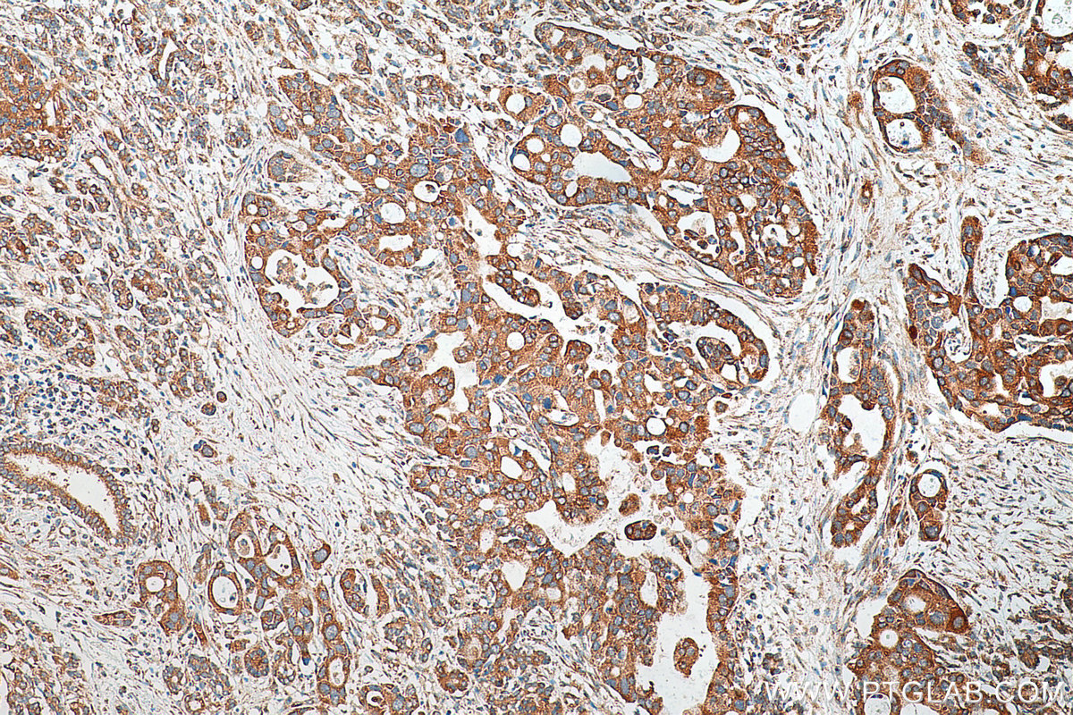 IHC staining of human pancreas cancer using 29800-1-AP