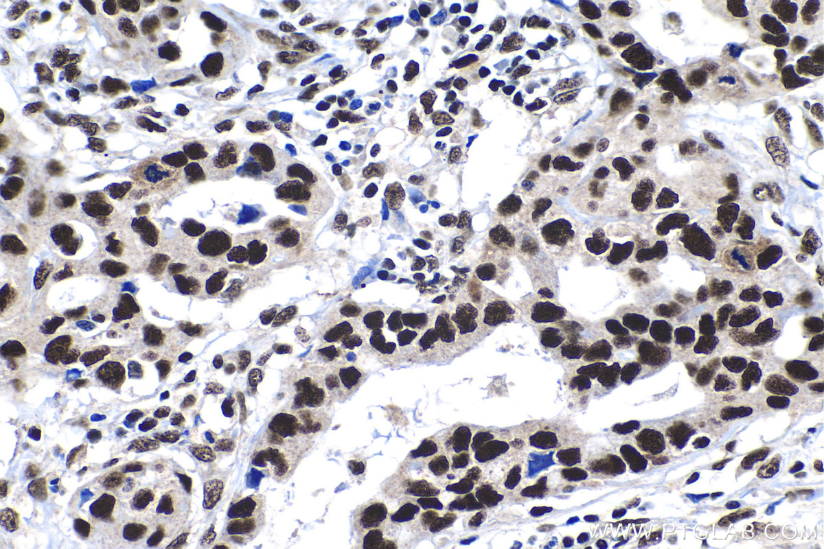 IHC staining of human lung cancer using 14995-1-AP